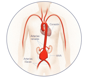 aorta abnormal