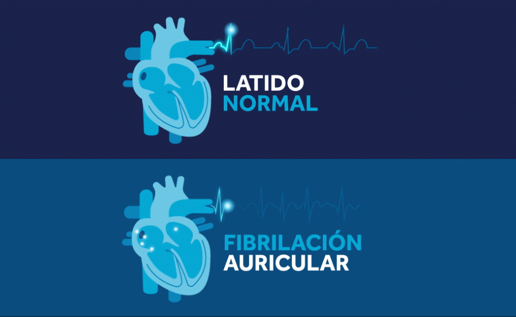 ladito normal del corazón - fibrilación auricular